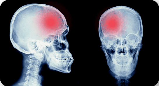 X-ray of TBI effects